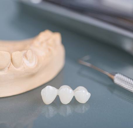 Dental bridge sitting next to a wax model