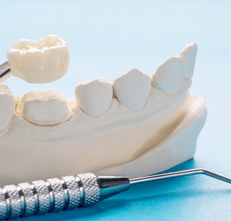 an example of a dental crown atop a wax model of teeth