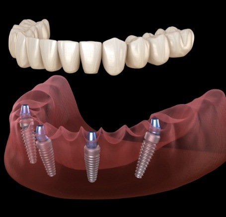 Illustrated full denture being placed onto four dental implants