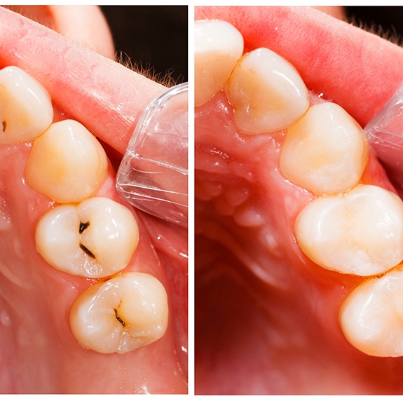 Before and after teeth with fillings
